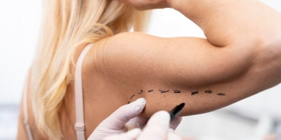 arm liposuction